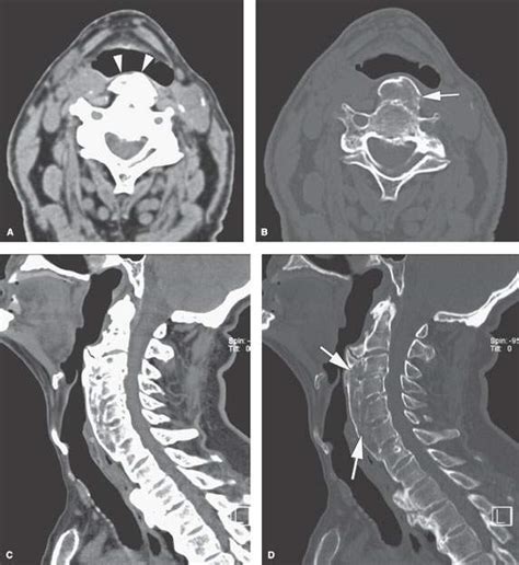 Hypopharynx Benign Noninflammatory Masses And Tumors Radiology Key