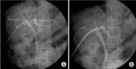 Cholangiography Findings A Percutaneous Transhepatic Biliary Drainage