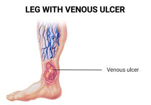 Venous Stasis Ulcer Causes Symptoms And Treatment