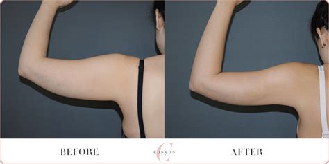 Liposuction Before And After Arms