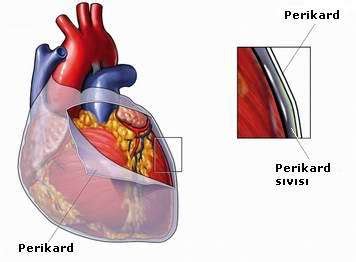 Pericardiectomy