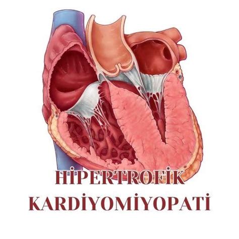 Hipertrofik Kardiyomiyopati Prof Dr Nevrez Koylan