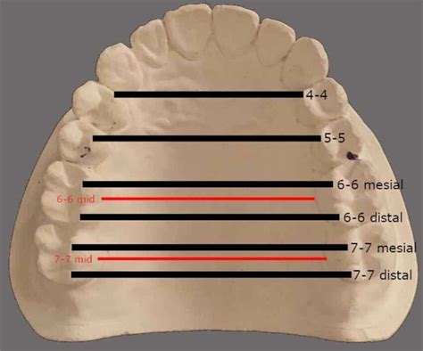 Maxillary Dental Arch Width Measurements Download Scientific Diagram