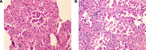 Figure 1 From Clinical Impacts Of A Micropapillary Pattern In Lung