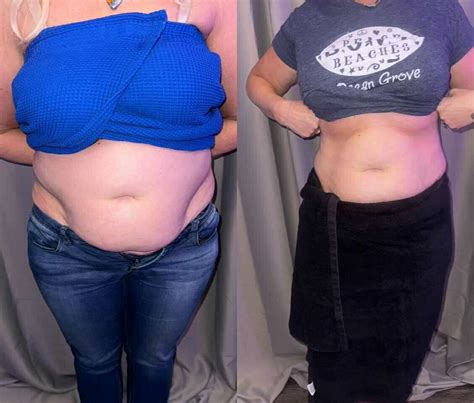 Glypto Cryo Machine | Revolutionary Dual-Mode Fat Freezing + EMS Device