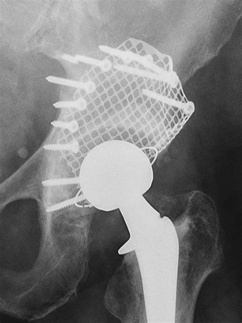 Favorable Early Results Of Impaction Bone Grafting With Reinforcement