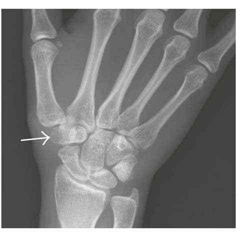 A Preoperative Radiography Of The Wrist Showing Nidus Arrow B