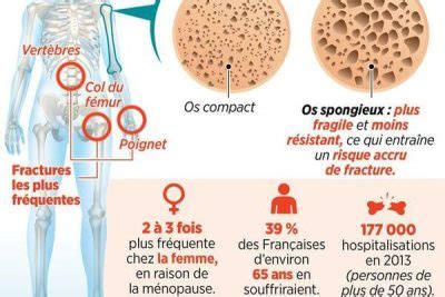 Prévenir l ostéoporose conseils simples et efficaces à suivre au