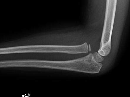 Radial Head Dislocation Image Radiopaedia Org