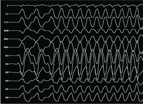 Rapid monomorphic VT of left bundle, right inferior axis morphology ...