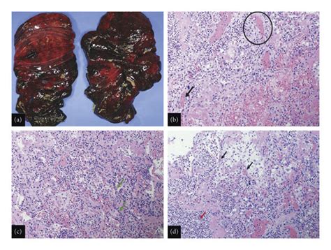 Gross Image Of The Right And Left Lungs A Shows Diffuse Bilateral