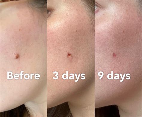 Before After Mole Removal Edition R SkincareAddiction