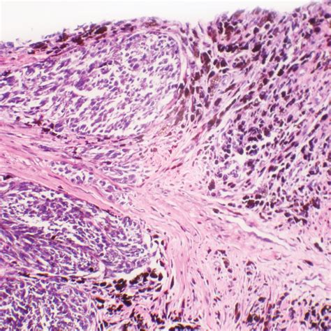 Human Melanoma Slide 7 µm H E Carolina Biological Supply