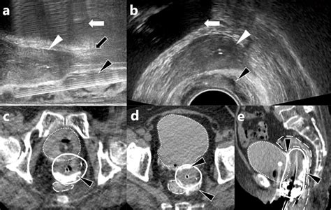 A And B Show Axial And Sagittal Views Of Transrectal Ultrasound Download Scientific Diagram