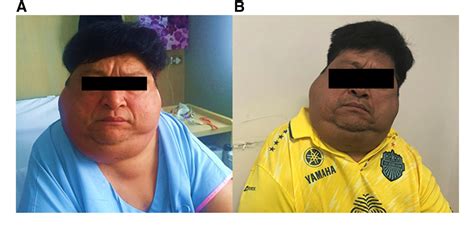 Figure 1 from A case of Madelung's disease presenting with obstructive ...