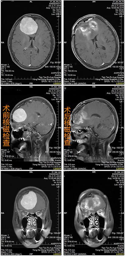 病例分享｜过渡型脑膜瘤一例治疗检查患者