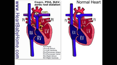 44 Coarctation of the Aorta, bicuspid aortic, aortic root dilation - YouTube