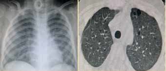 Chest Radiograph And Computed Tomography Postbilateral Povidone Iodine