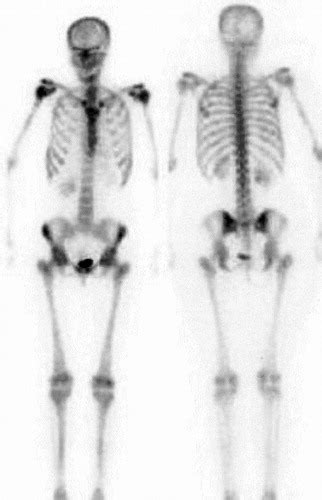 Radionuclide Bone Imaging An Illustrative Review Radiographics