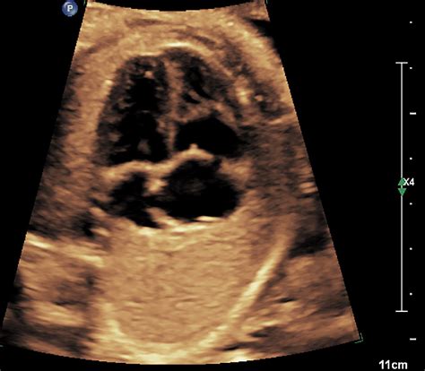 Figure From Prenatal Sonographic Findings Of Prominent Fetal