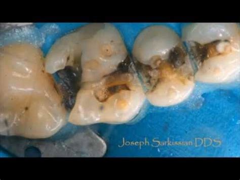 Safe Amalgam Removal By Dr Sarkissian YouTube