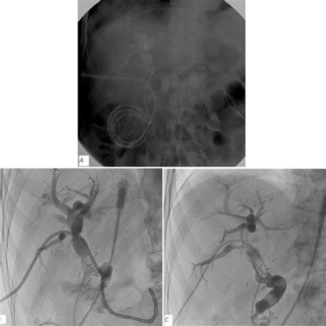 A Case Cholangiogram Showing A Large Filling Defect In The Common