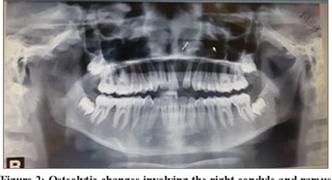 Figure 1 From Tuberculous Osteomyelitis Of The Mandibular Condyle A Rare Case Report And Review