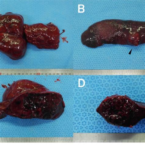 Gross Findings Of Resected Masses The Mass In The Torsed Left Lateral