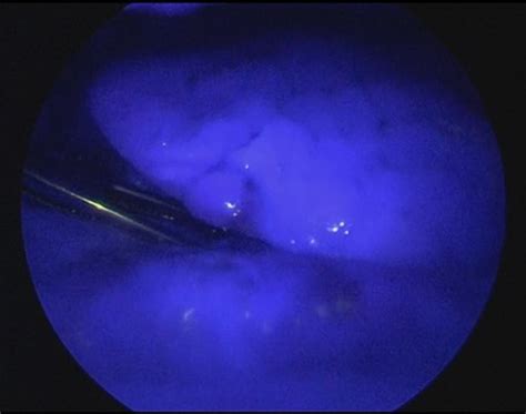 Intraoperative Indocyanine Green Fluorescence Imaging To Assess Lung