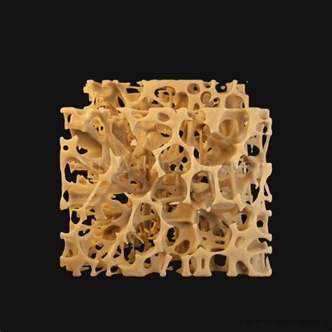 3D Trabeculae of Spongy Bone Osteoporosis Histology