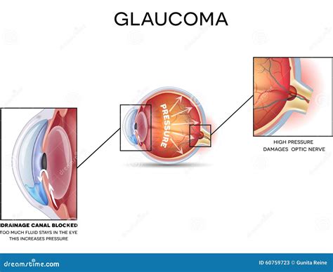 Glaucoma Ilustración Del Vector Ilustración De Enfermo 60759723