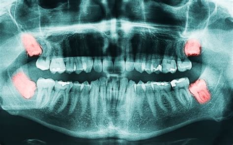 Facts about Horizontal Impacted Wisdom Teeth | ndortho.com