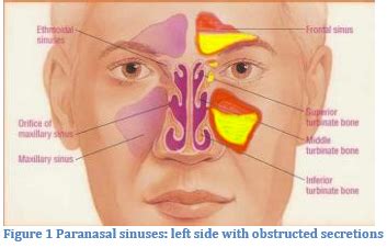 Balloon Sinuplasty In Office Sinus Surgery