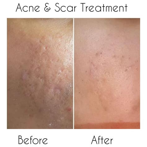 Best Acne Scars Treatment In Kolkata Cost Procedures And Results La Derma