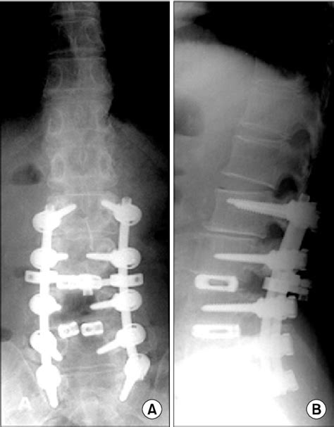 A B Immediate Postoperative Anteroposterior And Lateral Radiographs