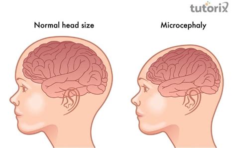 Cephalic Disorder