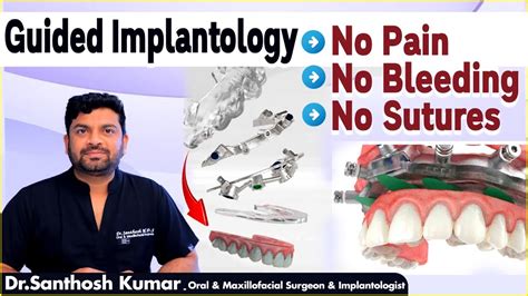 నపపలన ఇపలటస Painless Dental Implants in Telugu Guided