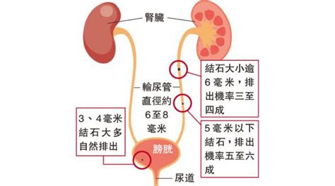 【腎石】少飲水易生腎石？尿液顏色愈深代表什麼？生活中如何保護腎臟健康？ 明報健康網