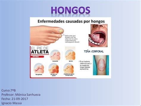 Enfermedades Producidas Por Hongos