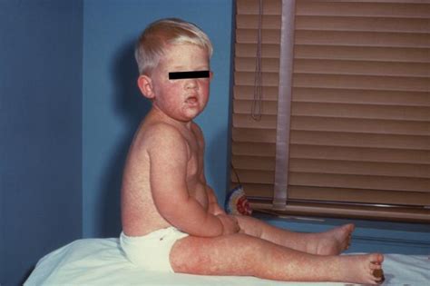 What To Know About Measles In The Us As Case Count Breaks Record Ars