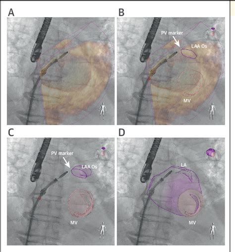 Figure 1 From Echocardiography Fluoroscopy Fusion Imaging For Guidance