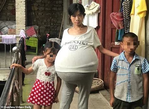 Chinese Mother Of Two Whose Belly Ballooned By Pounds Due To Ovarian