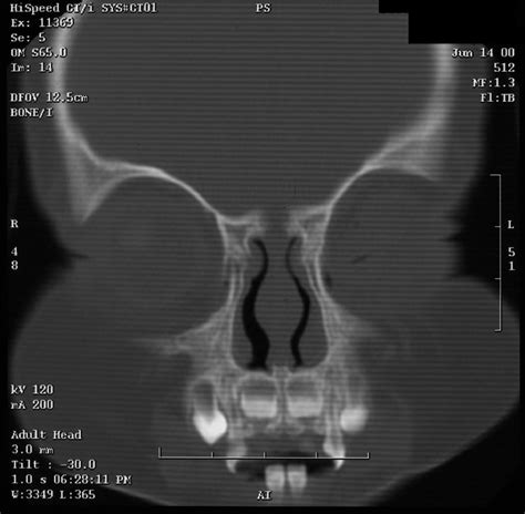 Surgical Management Of Nasal Dermoid Lesions Operative Techniques In