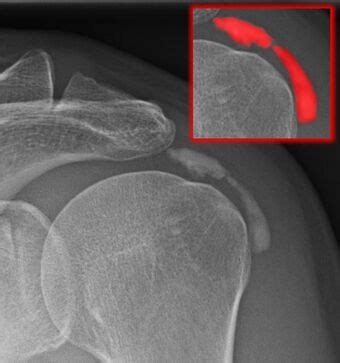 Medicine:Calcific bursitis - HandWiki