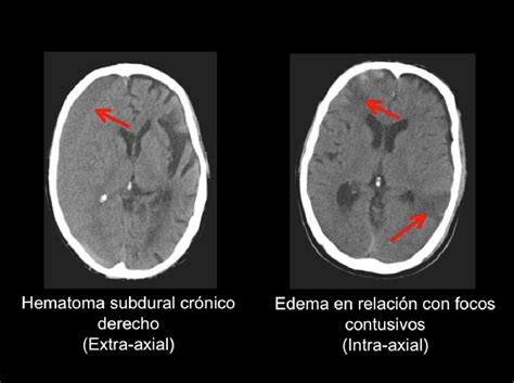 Tomografía Computarizada Del Cerebro