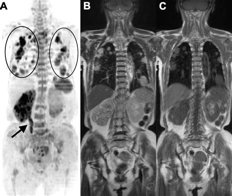 Whole Body Diffusion Weighted Magnetic Resonance Imaging European