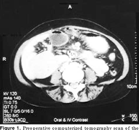 Figure 1 From Localized Castleman S Disease Presenting As A Vascular