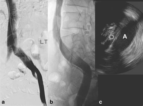 Transfemoral Venogram In Anteroposterior Ap View A And With 60° Download Scientific Diagram