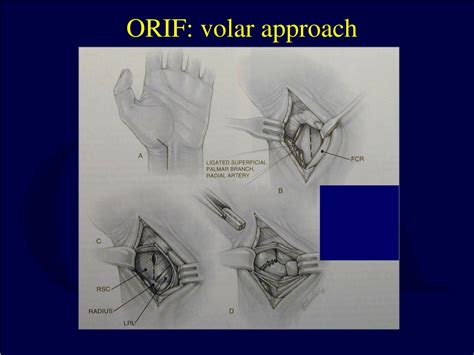 PPT Carpal Fractures And Dislocations PowerPoint Presentation Free