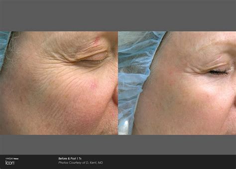 CO2 Fractional Laser Skin Resurfacing Newport Medical And Wellness Center